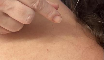 Acupuntura passa a ser oferecida nas unidades de saúde de Santa Helena e Nova Petrópolis